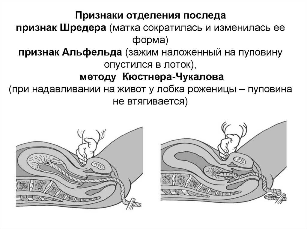 Способ абуладзе. приемы выделения отделившегося последа. методика осмотра последа и определение его целостности. третий период родов. гипотония и атония матки
