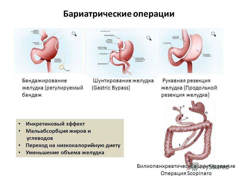 Резекция желудка по бильрот 1, 2 - резекция желудка по гофмейстеру финстереру