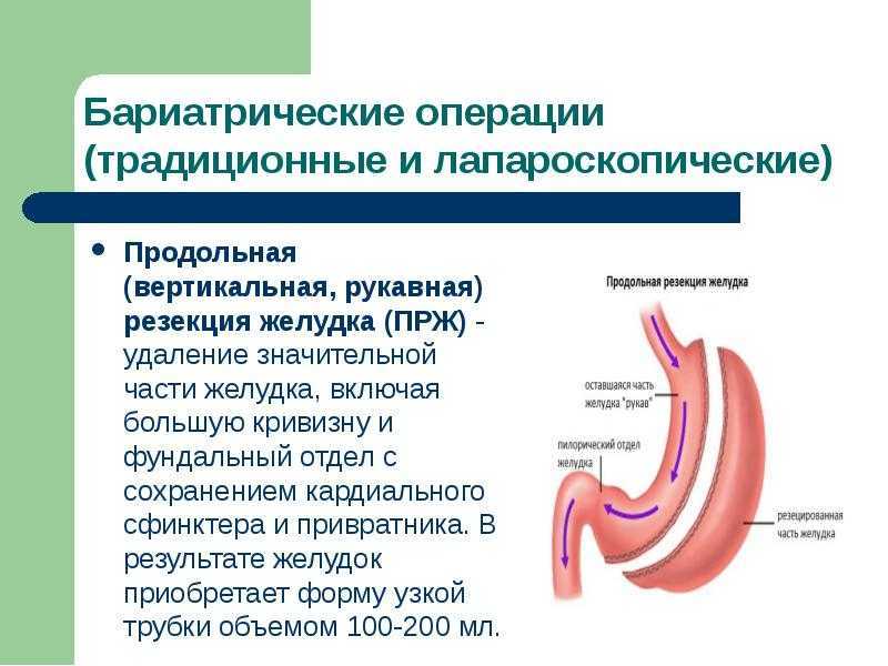 Резекция желудка - продольная, по бильрот 1 и 2, питание и диета