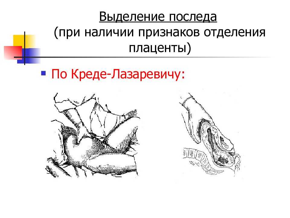 Определение признаков отделения последа